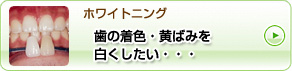 「ホワイトニング」歯の着色・黄ばみを白くしたい・・・