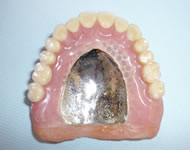 コバルトクロム総義歯