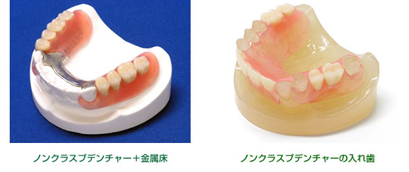 (左)ノンクラスプデンチャー+金属床(右)ノンクラスプデンチャーの入れ歯