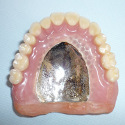 コバルトクロム総義歯
